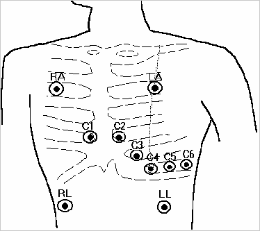 Arduino单导联心电检测传感器heart rate monitor